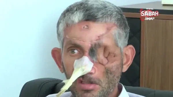 Hatay’da dişini çektiren bir kişinin gözünü kaybettiği iddia edildi