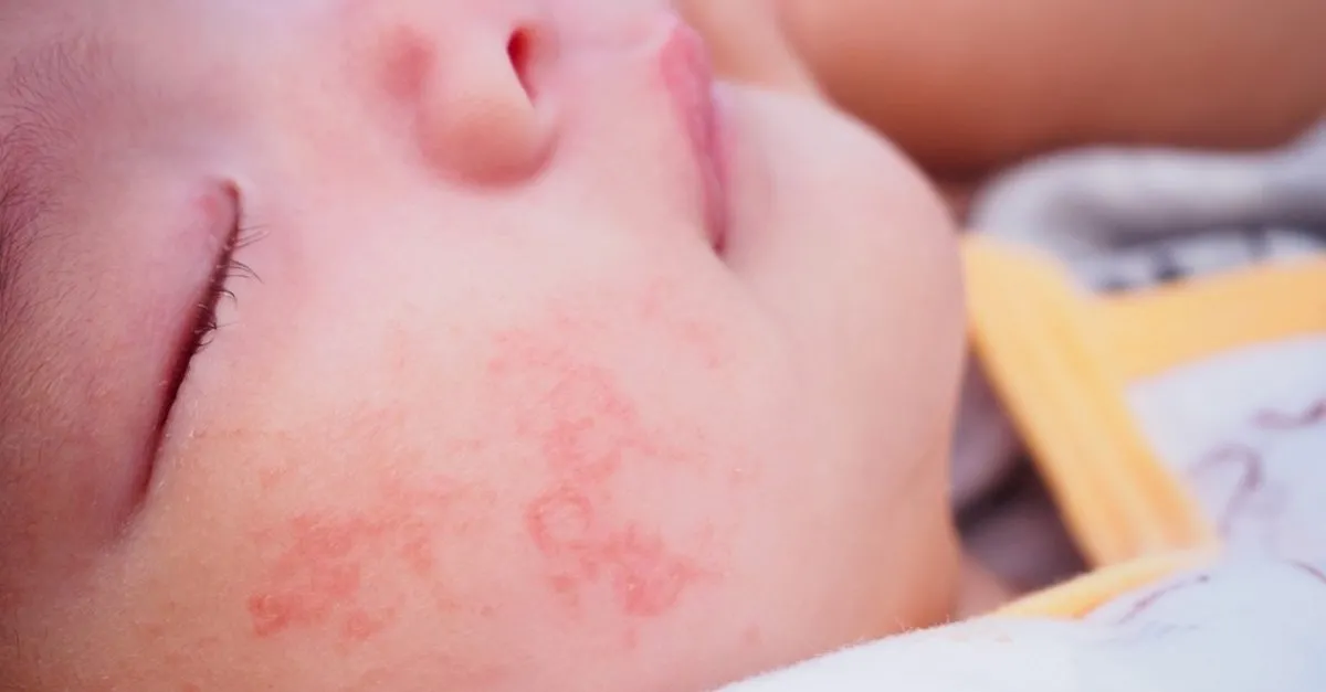 Bebeklerde Hangi Cilt Problemleri Gorulur Bebek Haberleri