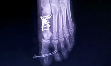 Yanlış parmağın ameliyat edildiği iddiası!