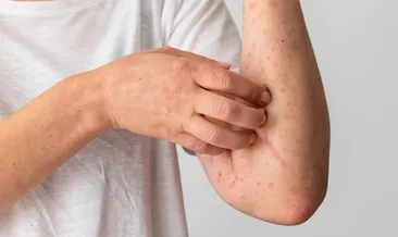 Kusma, karın ağrısı, ishal, nefes darlığı! Kene ısırığı öyle bir alerjiye sebep oluyor ki...