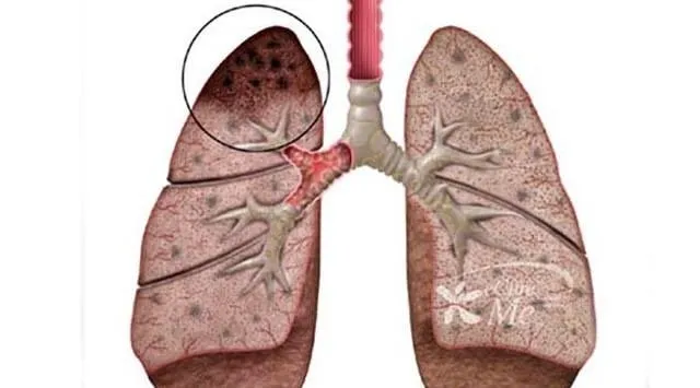 Akciğer kanseri tedavisi görenlere güzel haber