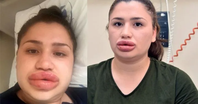 Estetik mağduru hemşireden haber var!