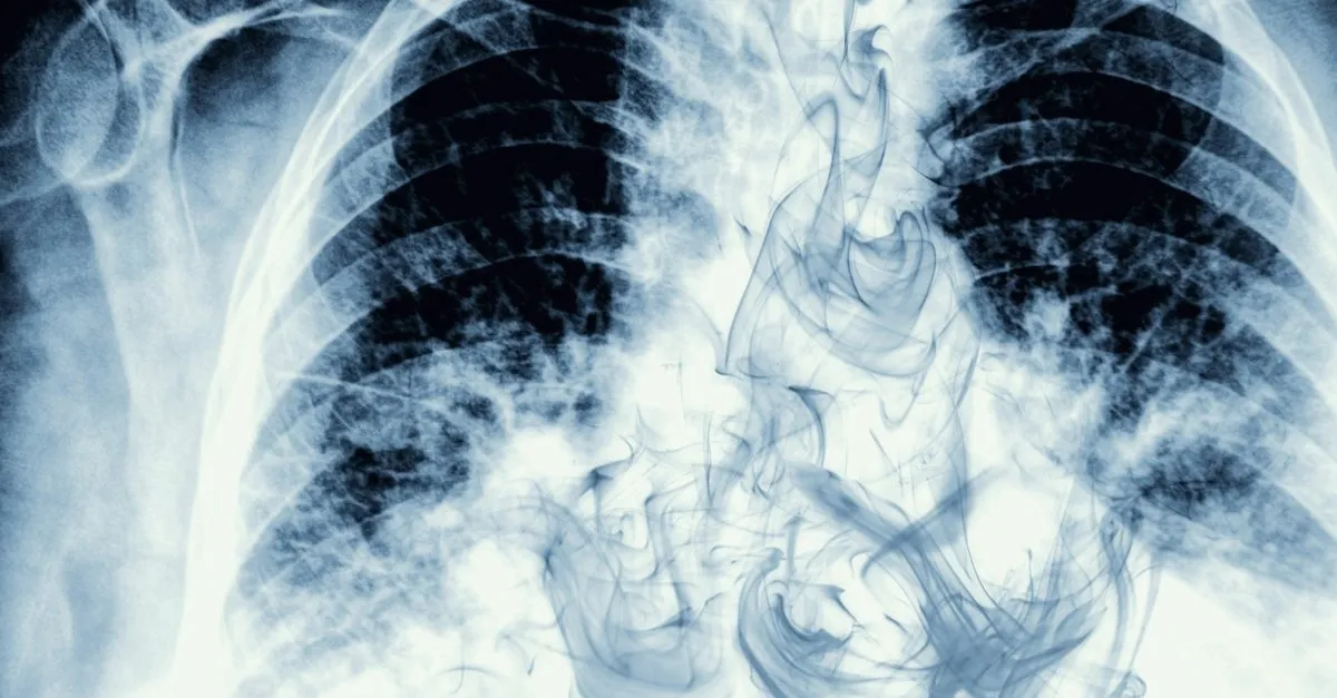 akciger kanseri belirtileri nelerdir