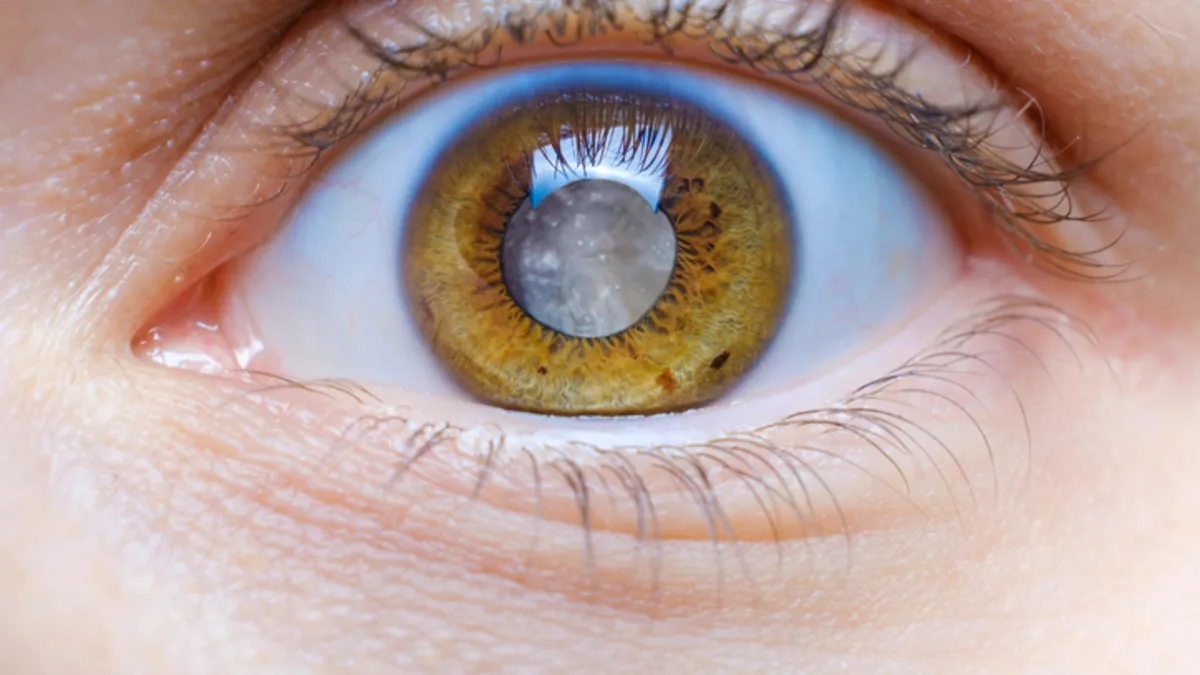 Doktorlar uyarıyor: Bu hastalık göz sağlığınızı sessizce yok ediyor! Doktorlar uyarıyor: Bu hastalık göz sağlığınızı sessizce yok ediyor!