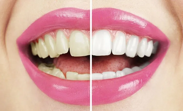 Diş rengi değişikliğine dikkat