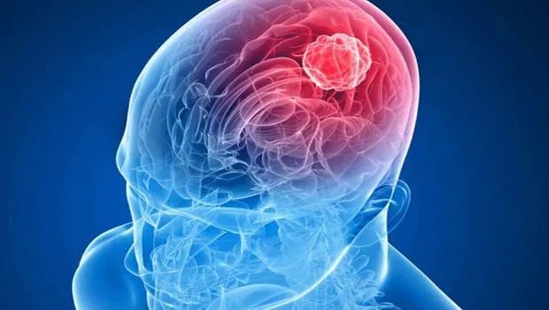 Beyin tümörü belirtileri nelerdir?