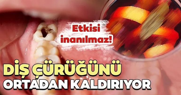 Bu besin diş çürüğüne engel oluyor! İşte diş çürüğüne engel olan mucizevi besinler