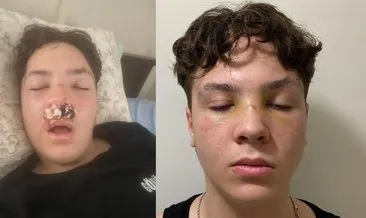 Lise çıkışı kavga: 15 kişi saldırıp burnunu kırdılar!