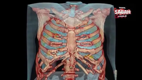 Corona virüsün bulaştığı hastanın 3D akciğer görüntüsü yayınlandı! İşte akciğerlere verdiği hasar... | Video