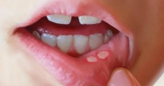 agzinizda cok sik aft olusuyorsa 4