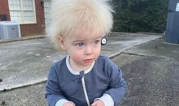 Bu sendrom dünyada sadece 100 kişide var! Saçlarıyla herkesi şaşkınlığa uğratan o bebek
