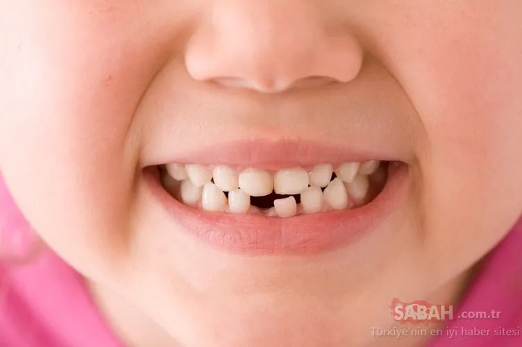 Çocuklarda diş muayenesi ne zaman yapılmalı?