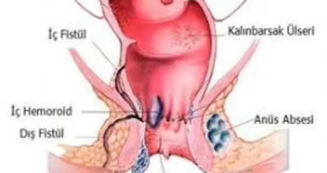 Anal kaşıntı nedenleri, sebepleri ve kimlerde görülür