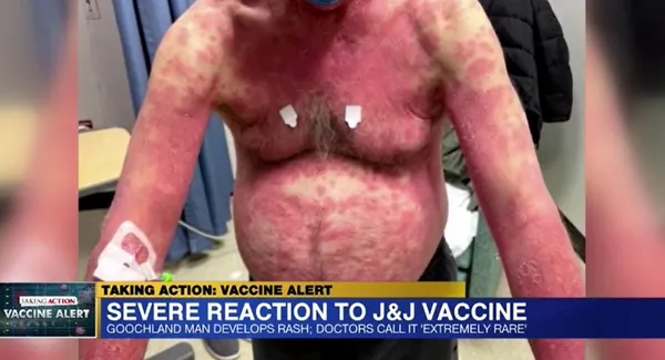 ABD’de koronavirüse karşı yapılan Johnson and Johnson aşısı bu hale getirdi