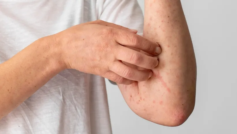 Kusma, karın ağrısı, ishal, nefes darlığı! Kene ısırığı öyle bir alerjiye sebep oluyor ki...