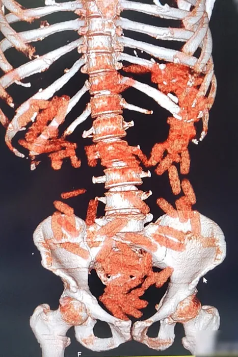 Kayseri’de düzenlenen operasyonda midesinden çıkanlar şoke etti: Tam 1 kilo!
