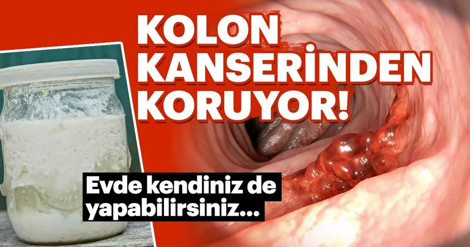 Kolon Kanserinin Belirtileri Nelerdir Kolon Kanserinden Korunmaya Faydali Besinler Nelerdir Saglik Haberleri