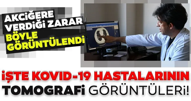 Corona virüs salgınından son dakika haberi: Akciğere verdiği zarar işte böyle görüntülendi! Tomografi görüntüleri...