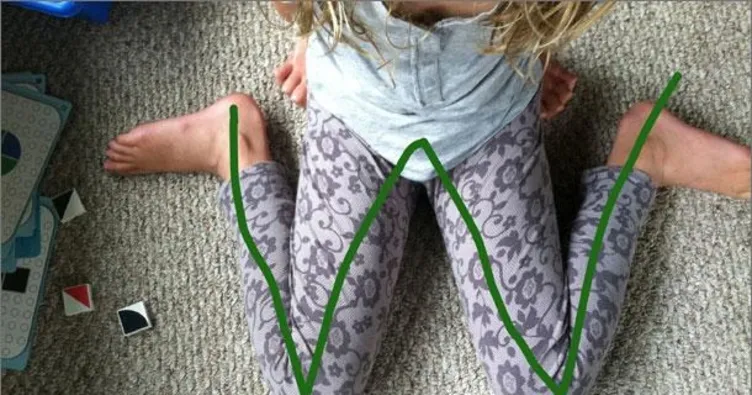 Çocuklarda W şeklinde oturuş zararlı mı?