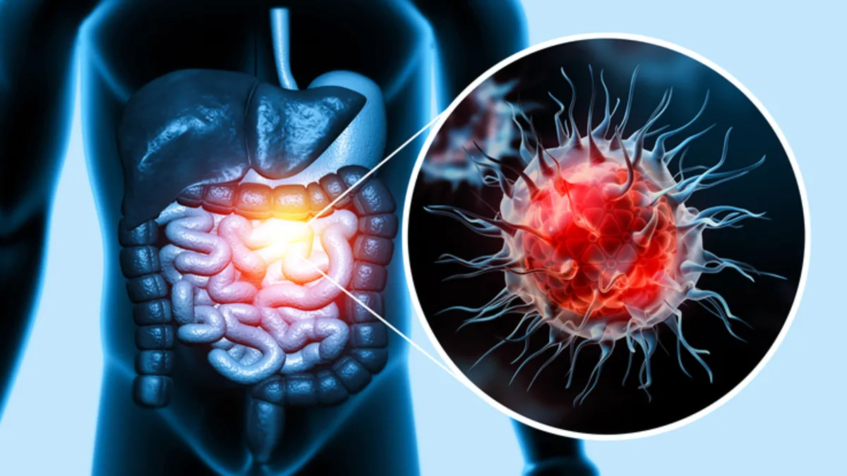 Sessiz ilerliyor: Kolon kanserinin en yaygın belirtileri açıklandı Sessiz ilerliyor: Kolon kanserinin en yaygın belirtileri açıklandı