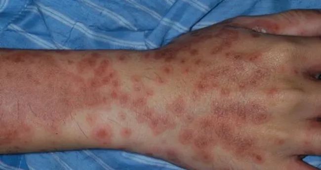 Frengi nedir? Frengi tedavisi nasıl olur?